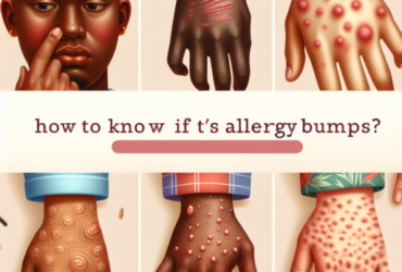 Comment savoir si c'est des boutons d'allergie ?